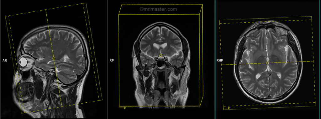 3D T1 SPACE coronal for epilepsy protocol planning image