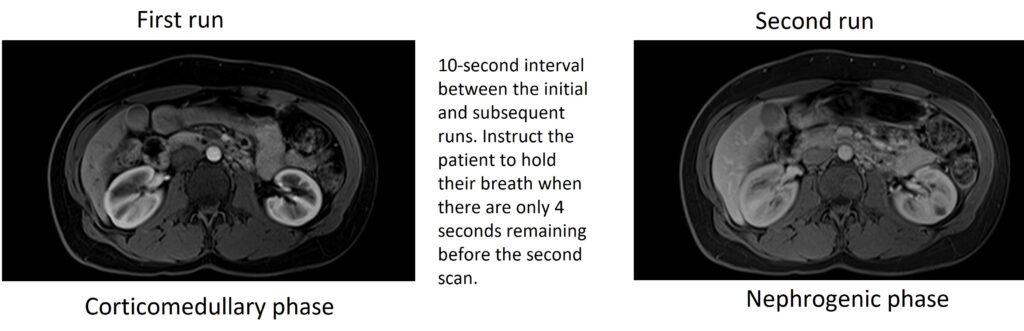Arterial and venous phase timing of kidney mri scan