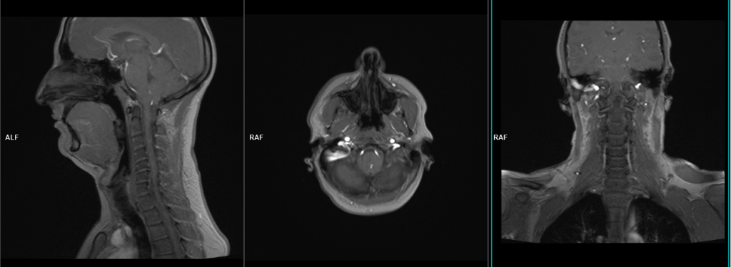 Magnetic resonance angiography (MRA) carotid artery planning and protocol localizer