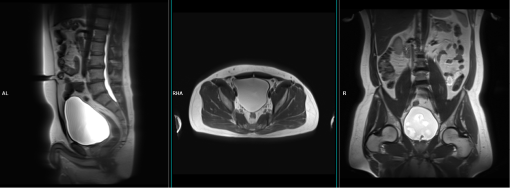 MRI BLADDER LOCALIZER