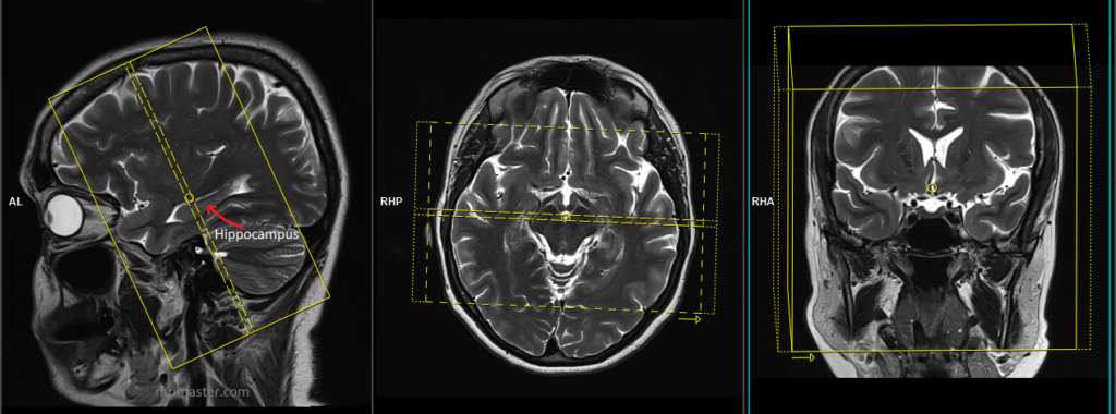 MRI EPILEPSY(seizure) PROTOCOL and planning image