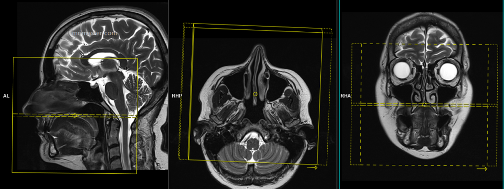 MRI Face planning and protocol of axial scans