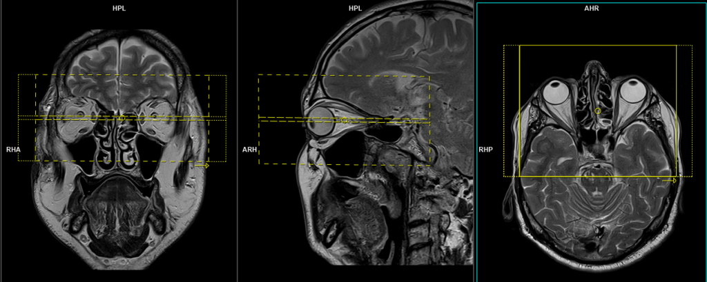 MRI ORBITS PLANNING OF AXIAL SCANS