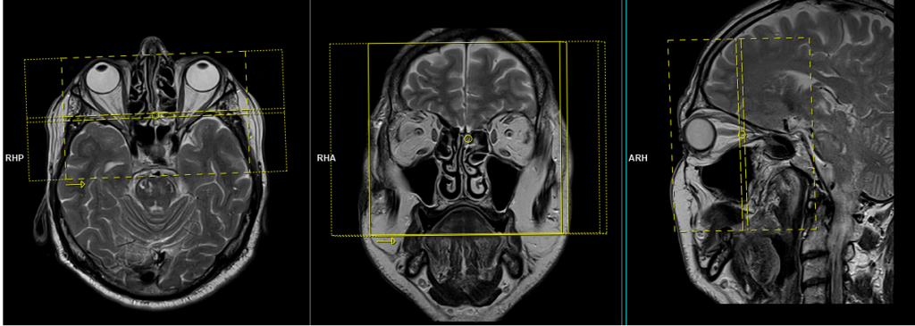 MRI ORBITS PLANNING OF CORONAL SCANS