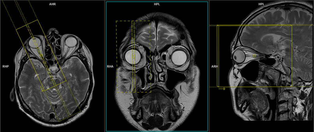 MRI ORBITS PLANNING OF SAGITTAL