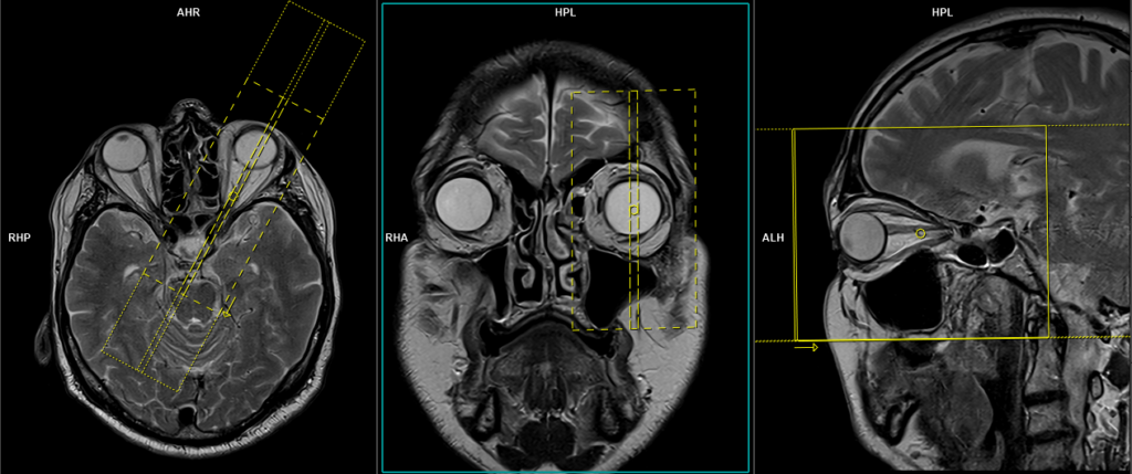 MRI ORBITS PLANNING and protocol of sagittal left side