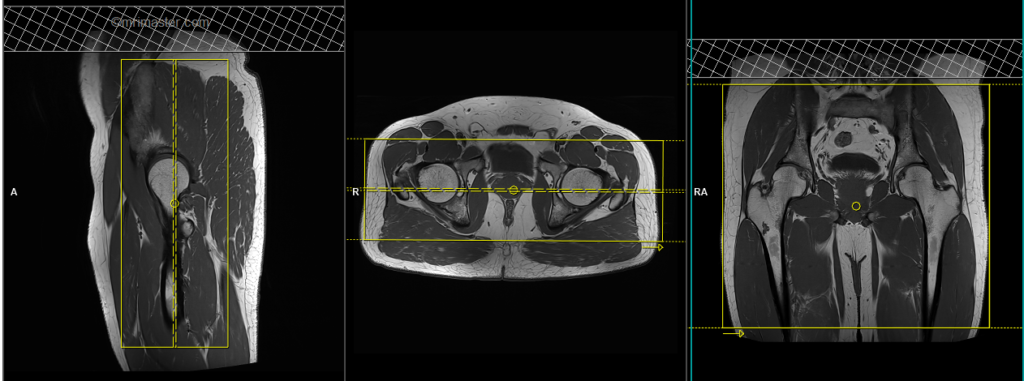 MRI PLANNING OF HIP CORONAL