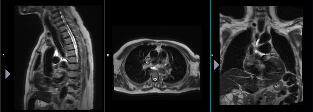 MRI STERNUM LOCALIZER
