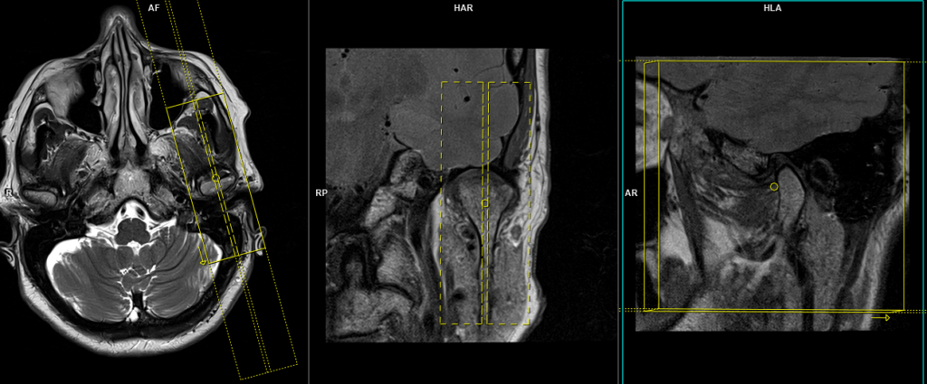 MRI TMJ Planning of sagittal left side open mouth scans