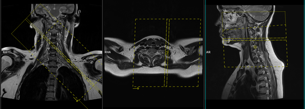 MRI brachial plexus planning of axial oblique scans