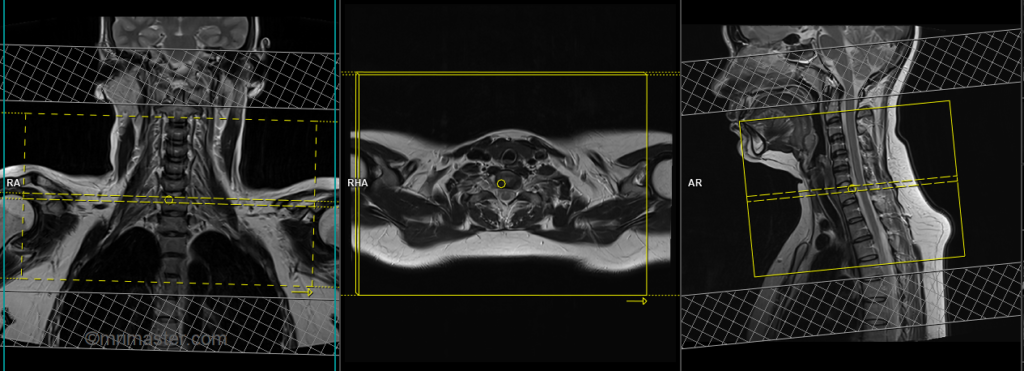 MRI brachial plexus planning of axial scans