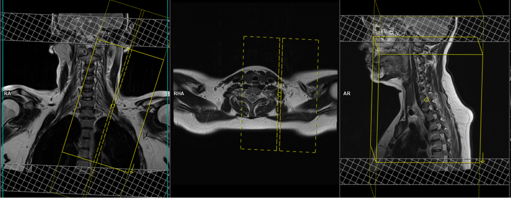 MRI brachial plexus planning of sagittal oblique scans