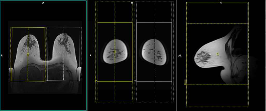 MRI breast protocol and planning of sigital both side scans