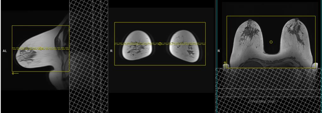 MRI breast protocol and planning of zoomit or epi DWI scans