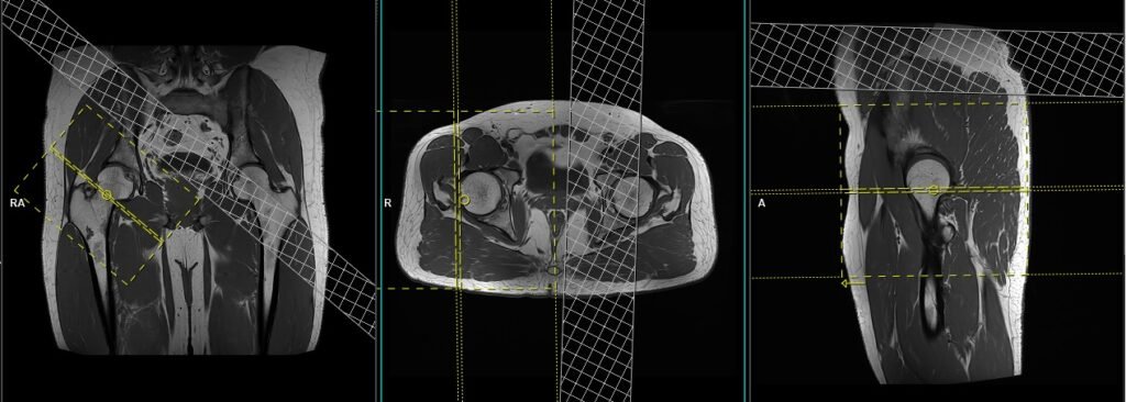 MRI hip planning and protocol of sagittal oblique scans