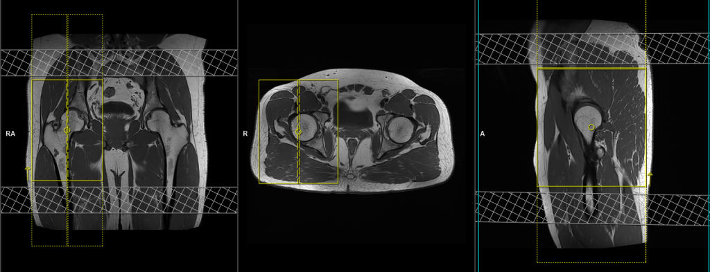 MRI hip planning and protocol of sagittal scans