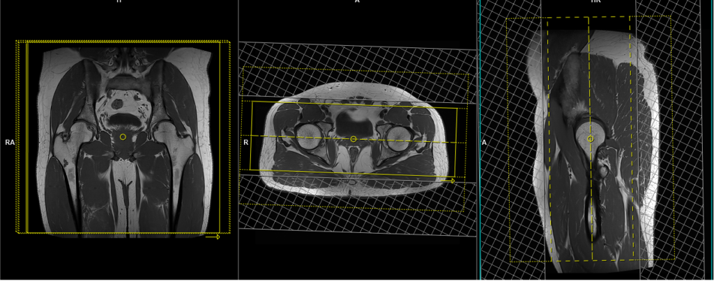 MRI hip planning of coronal 3d SPACE scans