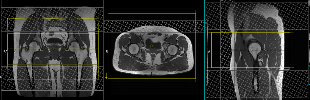 MRI hips planning of axial 3d scans