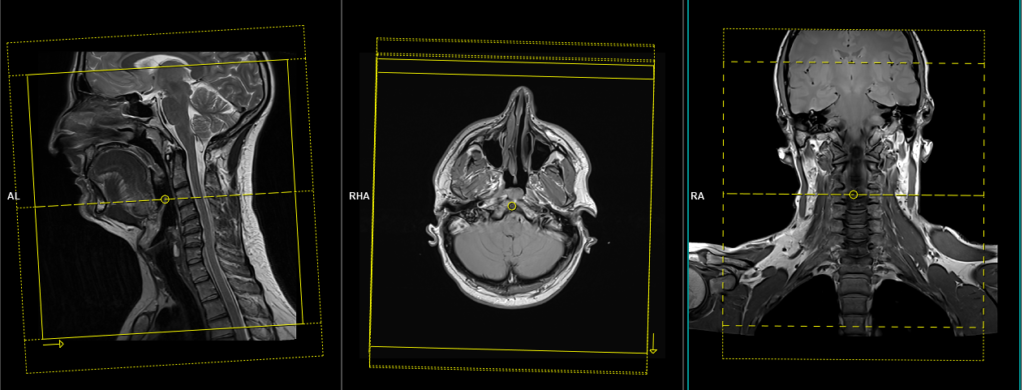 MRI mri soft tissue neck planning and protocol of axial 3D scans