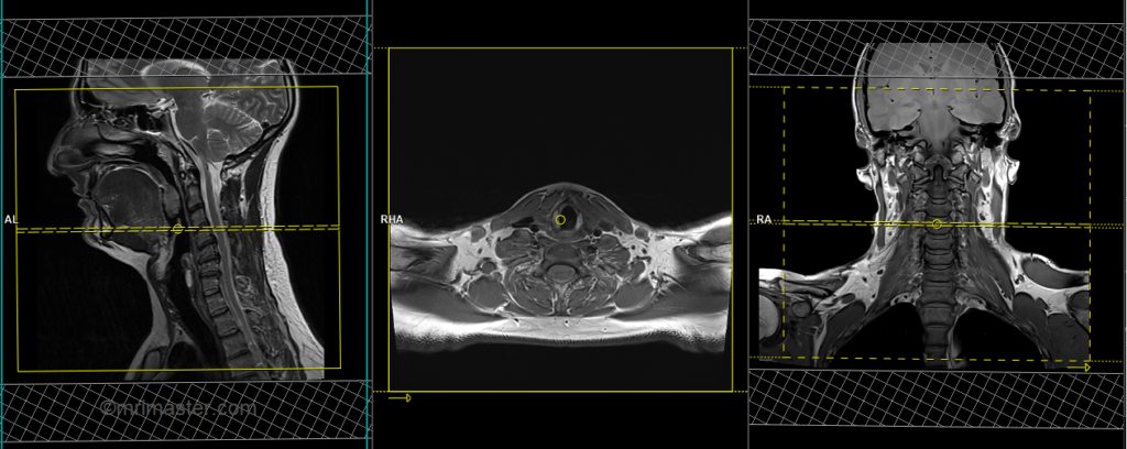 MRI mri soft tissue neck planning and protocol of axial scans