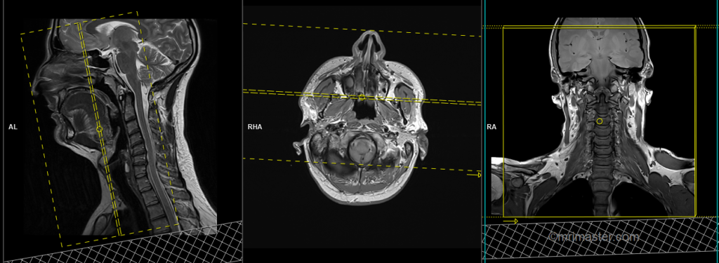 MRI mri soft tissue neck planning and protocol of coronal scans