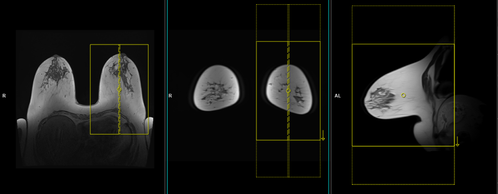 MRI planning of breast scan sagittal lt