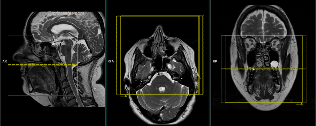 MRI trigeminal nerve Planning of axial scans
