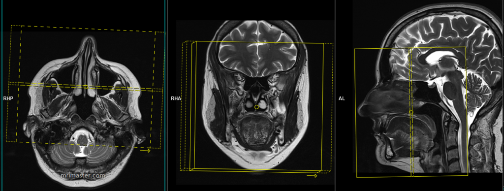 MRI trigeminal nerve Planning of coronal scans