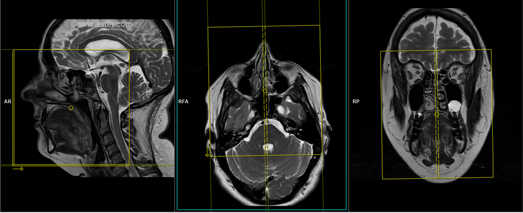 MRI trigeminal nerve Planning of sagittal scans