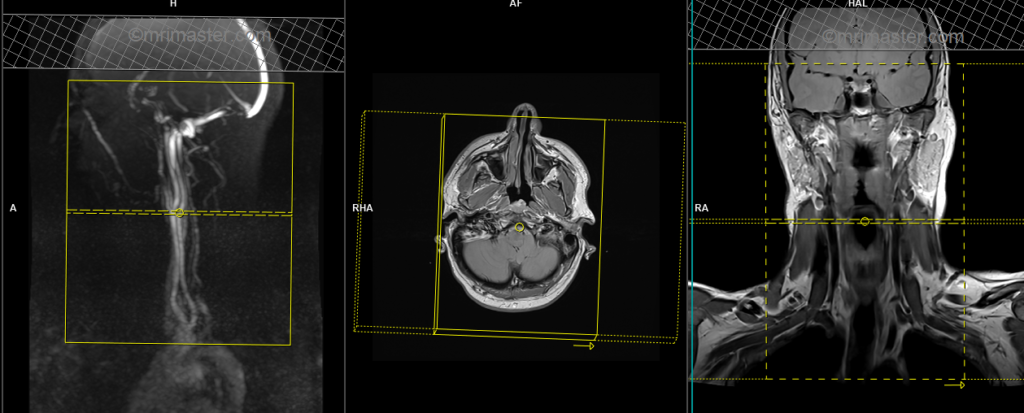 Magnetic resonance angiography (MRA) carotid artery planning and protocol of axial T1 fat saturated scans