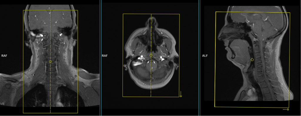 Magnetic resonance angiography (MRA) carotid artery planning and protocol localizer
