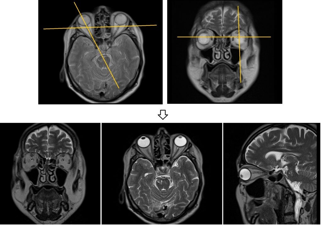 Orbit MRI localiser planning image