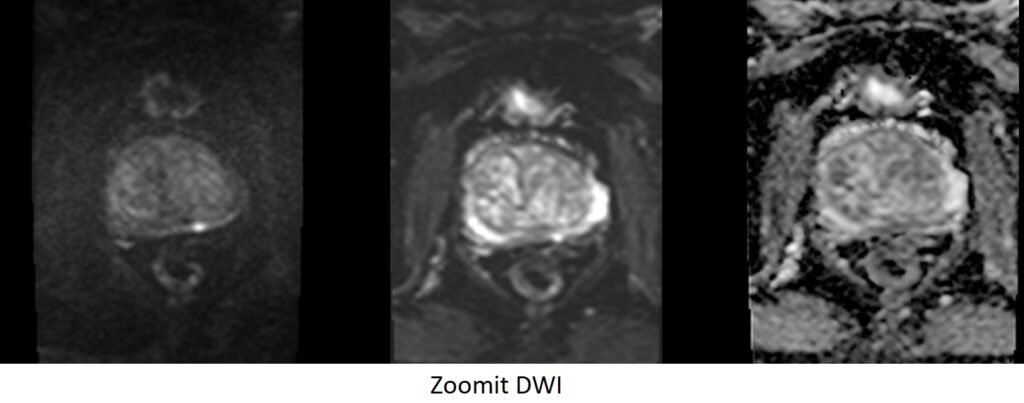 Zoomit DWI images