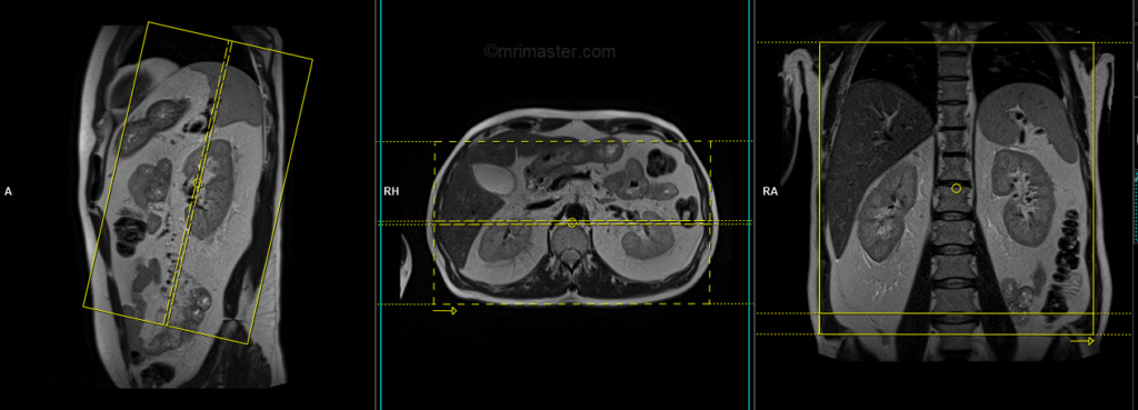 adrenal mri planning of coronal images