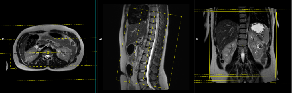 mra renal planning
