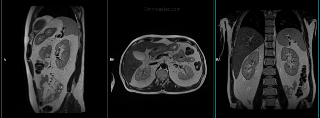 mri adrenal gland localiser image