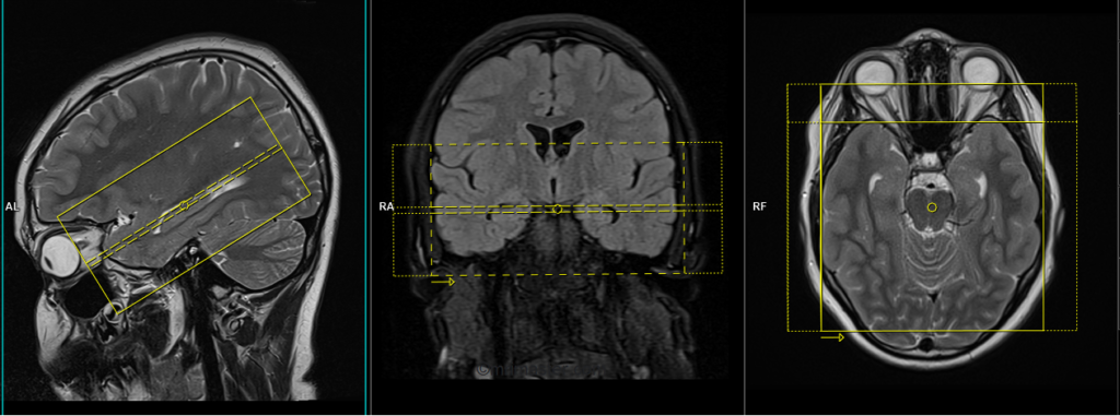 mri epilepsy protocol and planning of axial oblique scans