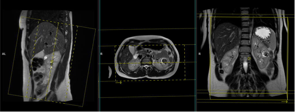mri kidney scan coronal planning and protocol image