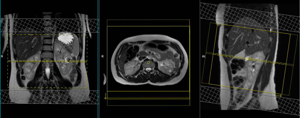 mri kidneys planning of axial images
