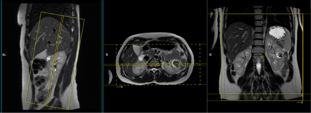 mri kidneys planning of coronal images