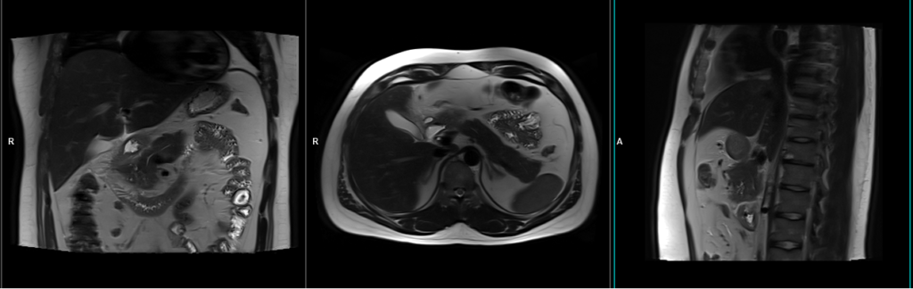 mri pancreas localizer