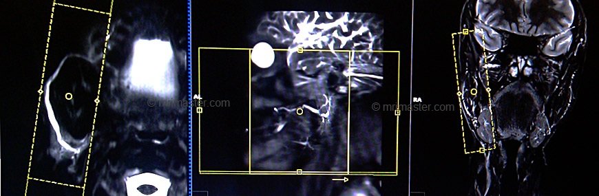 mri parotid sialography sagittal haste planning