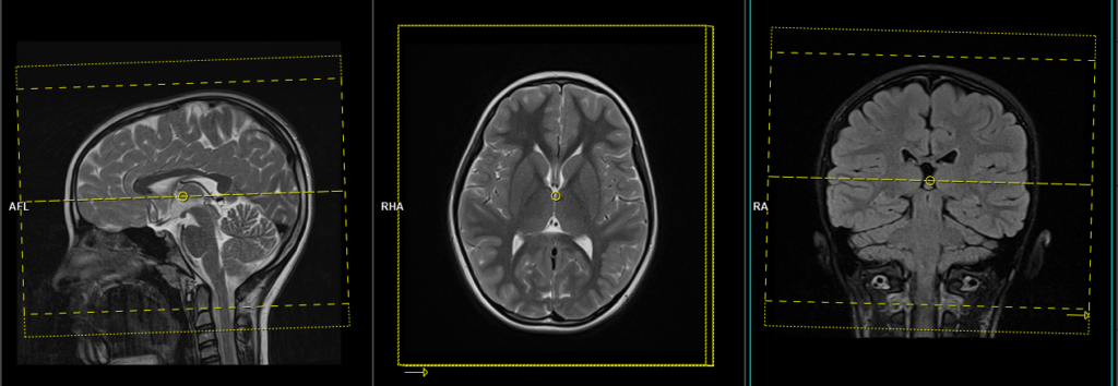 mri pediatric brain axial 3D planning
