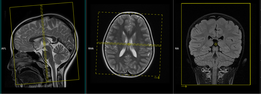 mri pediatric brain coronal planning