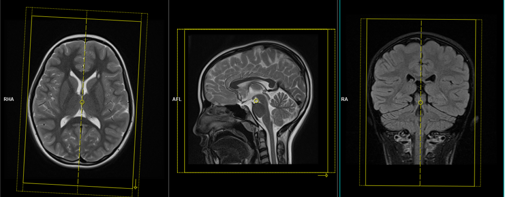 mri pediatric brain sagittal 3d planning