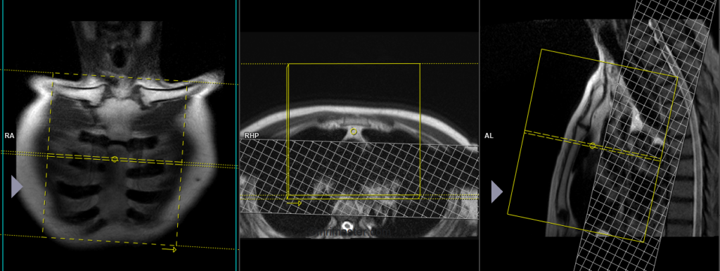 mri planning for strnum axial scans