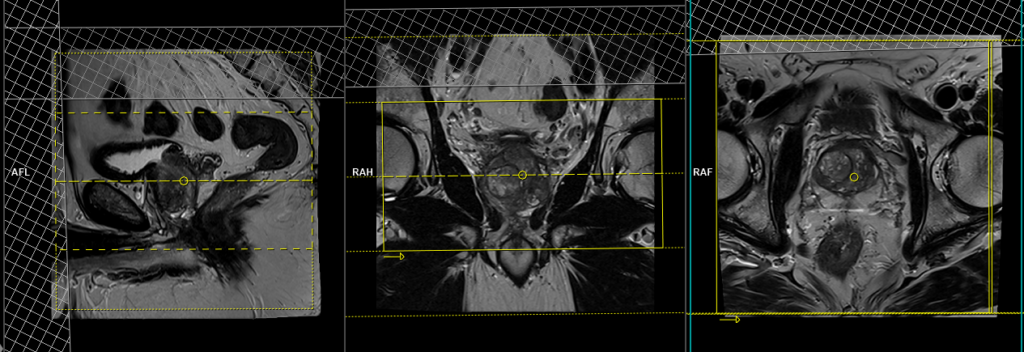 mri prostate axial twist dixon dynamic small fov planning