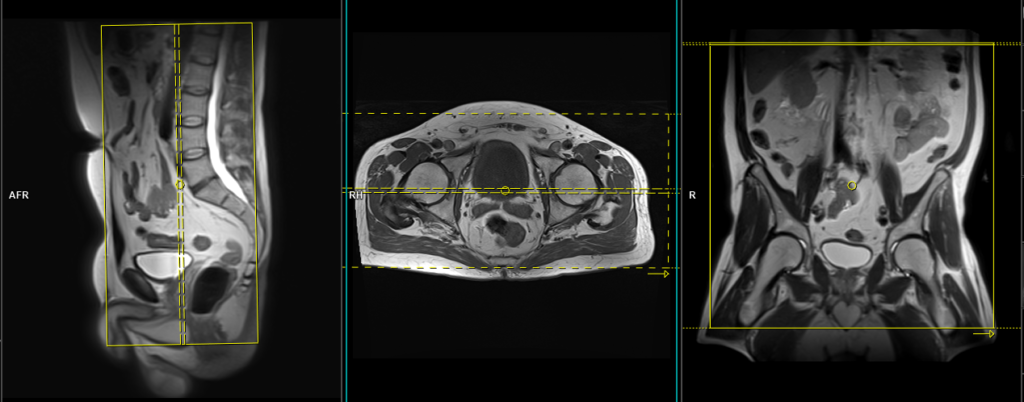 mri prostate coronal big fov planning