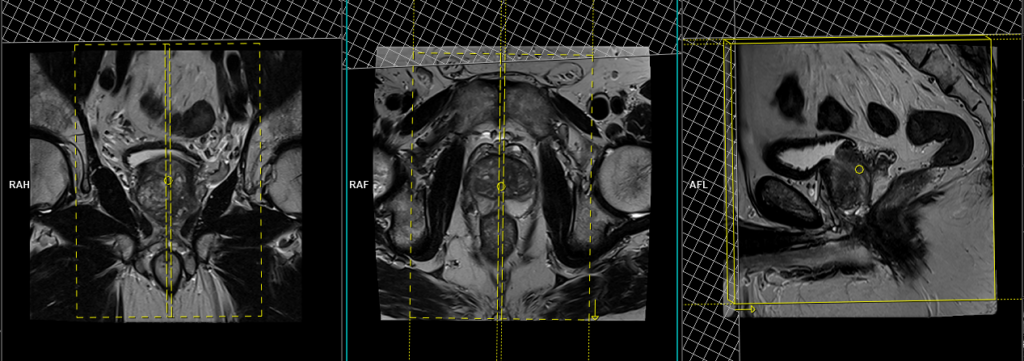 mri prostate sagittal small fov planning