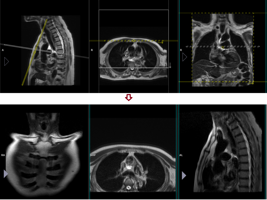 mri sternum localizer planning